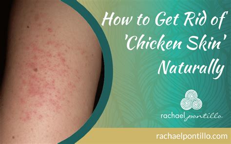 How to Get Rid of 'Chicken Skin'--AKA Keratosis Pilaris--Naturally