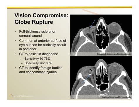 Imaging of Facial Trauma