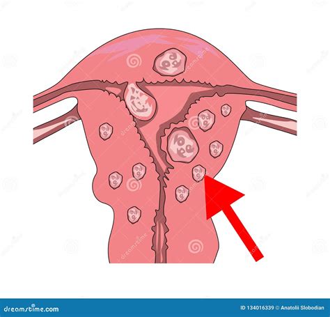 Myoma Of The Uterus Cartoon Vector | CartoonDealer.com #74502819