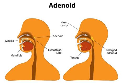 Enlarged Adenoids in Kids: Reasons, Signs & Treatment