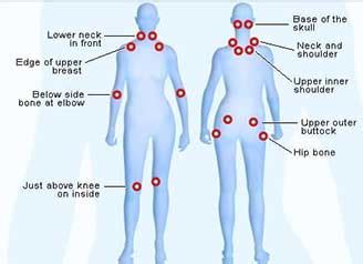 fibromyalgia-trigger-points | Complete Spine and Pain Care