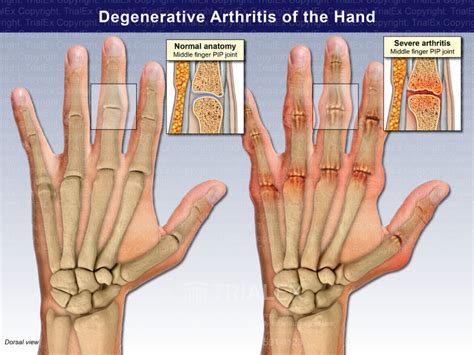 Degenerative Arthritis of the Hand - TrialExhibits Inc.