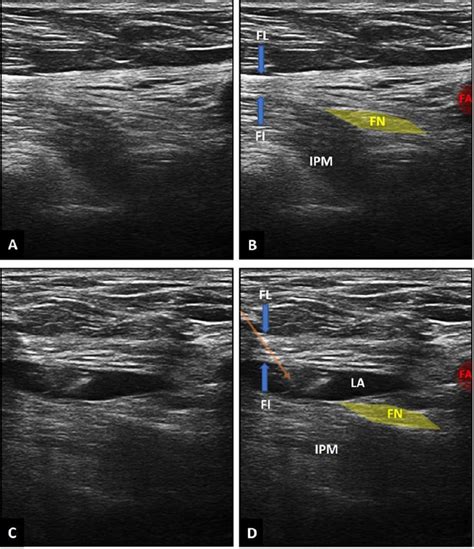 Ultrasound guided demonstration of the fascia iliaca compartment block:... | Download Scientific ...