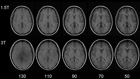 3 Tesla Mri Disadvantages