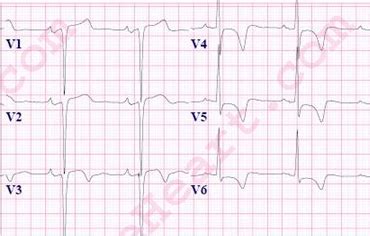 Left Ventricular Hypertrophy (LVH) ECG Review | Learn the Heart