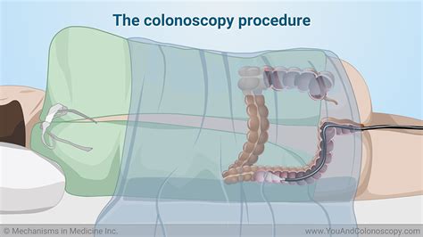 What happens during and after a colonoscopy?