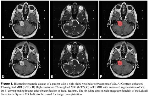 VESTIBULAR-SCHWANNOMA-SEG - The Cancer Imaging Archive (TCIA)