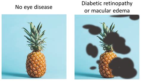 Diabetic Maculopathy: Understanding and Managing Vision Complications - DR. AHMED EL KHASHAB