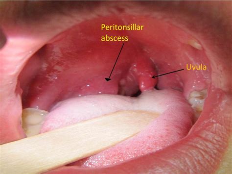 Peritonsillar abscess physical examination - wikidoc