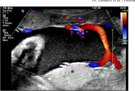 Figure 4 from Succenturiate lobe of placenta with vessel anomaly: a case report of prenatal ...