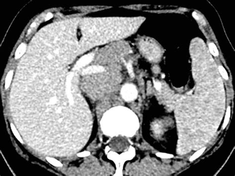 Spleen | Radiology Key