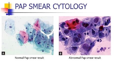 The Bethesda system of reporting thyroid pathology | www ...