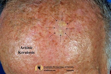 Actinic Keratosis: Treatment-Cryotherapy - Academic Dermatology of Nevada