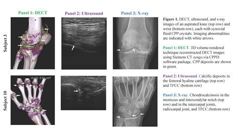 Gout Vs Pseudogout Crystals