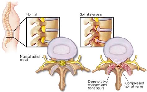 SERIOUSLY? Those with long-term spinal cord injuries at a greater risk ...