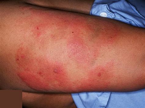 Thrombocytopenia - Causes, Signs, Symptoms, Diagnosis, Treatment