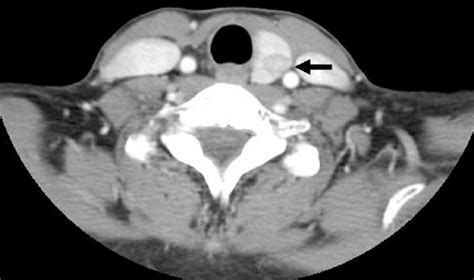 Preoperative axial CT scan shows left thyroid lobe with heterogeneous... | Download Scientific ...