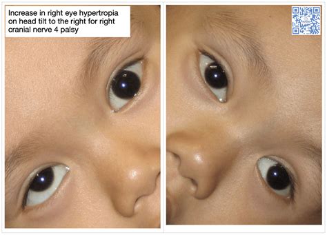 Cranial Nerve Palsy | 3rd nerve palsy | 4th nerve palsy | 6th nerve palsy