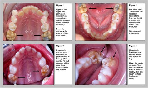 Hypoplastic and Hypomineralised Teeth