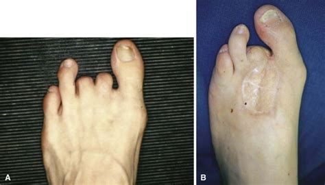 Diabetic Foot | Clinical Gate