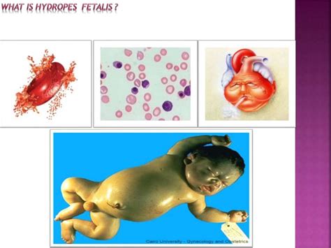 Hemolytic Disease of the newborn ( RH Isoimmunization )