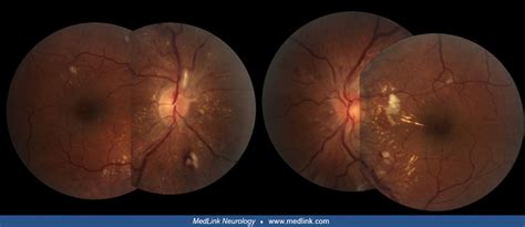 Hypertensive encephalopathy | MedLink Neurology