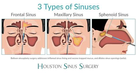 Houston Balloon Sinuplasty Surgery - Houston, TX: Houston Sinus Surgery