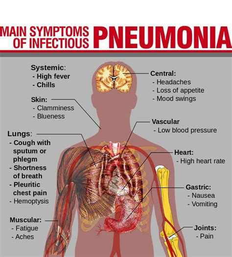 Pneumonia - Symptoms, Causes & Treatment - Santripty