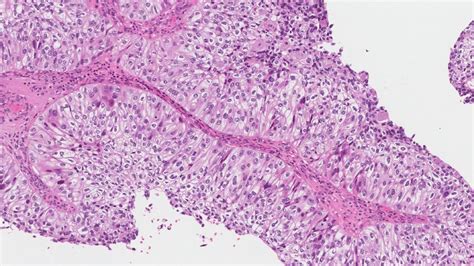 High grade papillary urothelial carcinoma | MyPathologyReport.ca