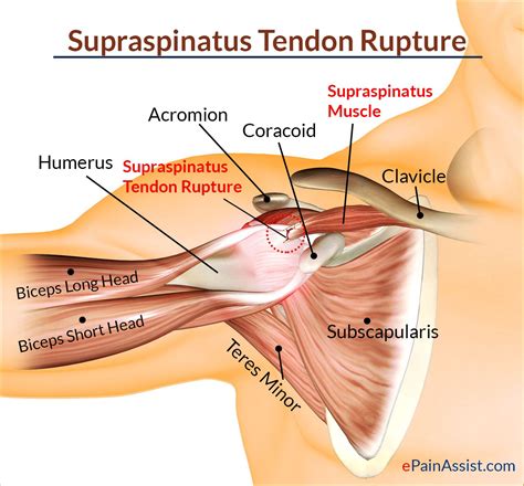 Supraspinatus Rupture: Treatment, Causes, Symptoms, Diagnosis | Supraspinatus muscle, Muscle ...