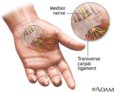 Carpal tunnel syndrome: MedlinePlus Medical Encyclopedia