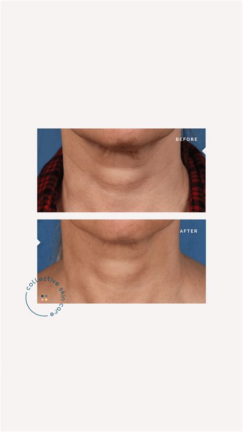 How to solve tech neck; Microneedling for neck wrinkles - Collective Skin Care