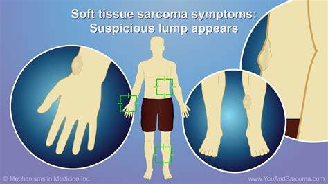 Diagnosing and Treating Soft Tissue Sarcoma