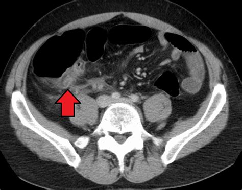 Appendix Pain | Causes, Pictures, Symptoms, Diagnosis & Treatment