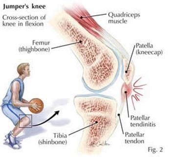 Jumper's Knee | What it is and Exercises & Stretches to Treat it