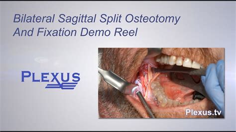 Bilateral Sagittal Split Osteotomy - YouTube