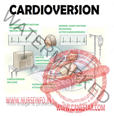 CARDIOVERSION - Nurse Info