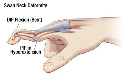 Swan Neck Deformity | Oh My Arthritis