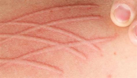 What You Need To Know About Fibromyalgia Skin disorders