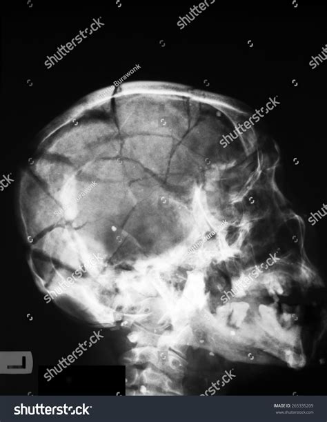 2,320 Skull Fracture X Rays Images, Stock Photos & Vectors | Shutterstock