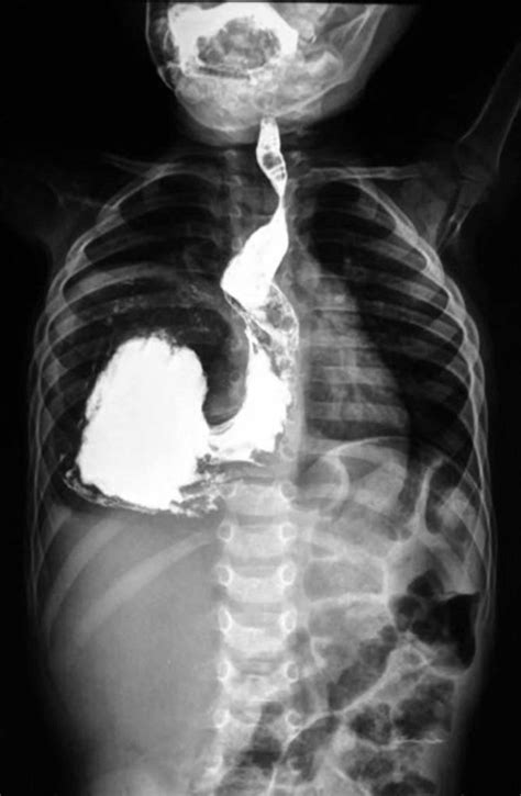 Volvulus definition, causes, volvulus types, diagnosis & volvulus treatment