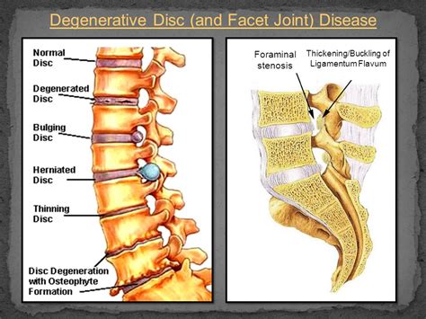 Degenerative Disease Dr. Sharifa AL-Duraibi. - ppt video online download