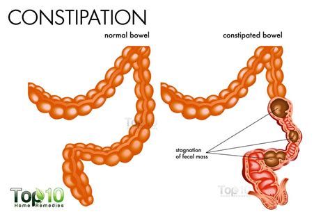 Doctors’ Best Home Remedies For Quick Constipation Relief