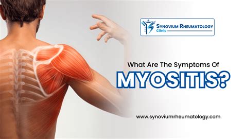 What are the symptoms of Myositis? | Synovium Rheumatology