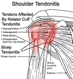 Shoulder Tendonitis