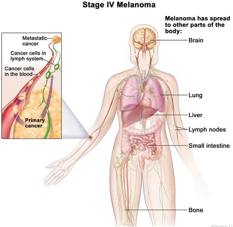 Cancer In Lymphatic System Life Expectancy - CancerWalls