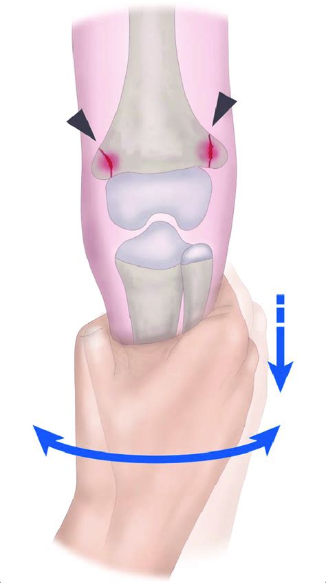 Illustration depicting the mechanism underlying a classic metaphyseal... | Download Scientific ...