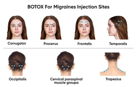 Botox for Tension Headaches - Cosmetic Surgery Tips