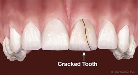 What Should You Do If You Have a Cracked Tooth? - Center for Restorative & Cosmetic Dentistry