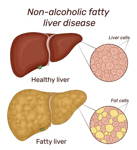 What Are The Causes of Non-Alcoholic Fatty Liver Disease (NAFLD ...